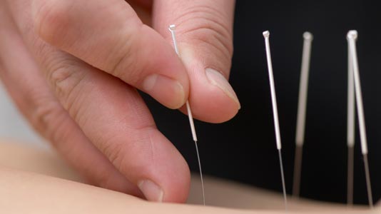 Patient receiving acupuncture