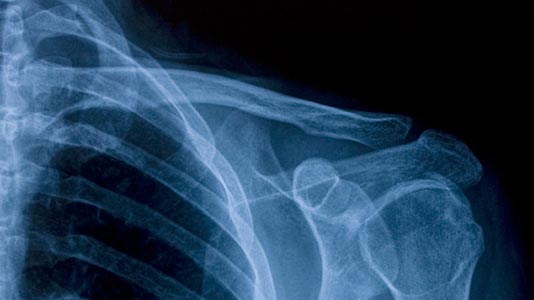 An X-Ray of a shoulder